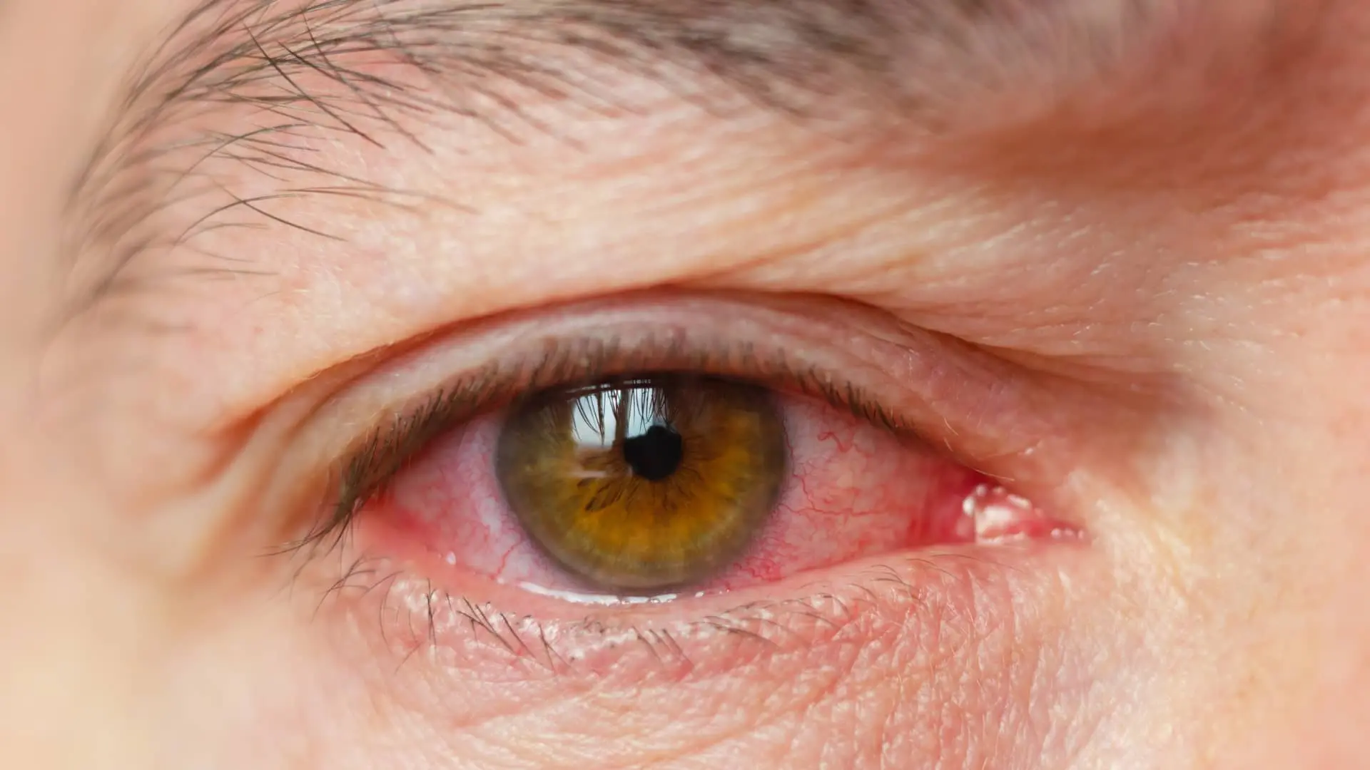 Enfermedades oculares que la contraindican