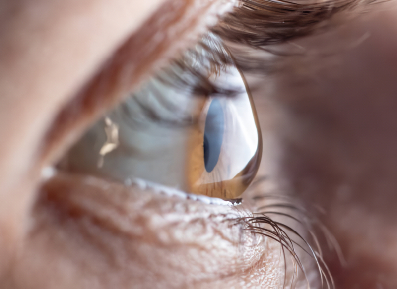 ¿Cómo prevenir el astigmatismo?