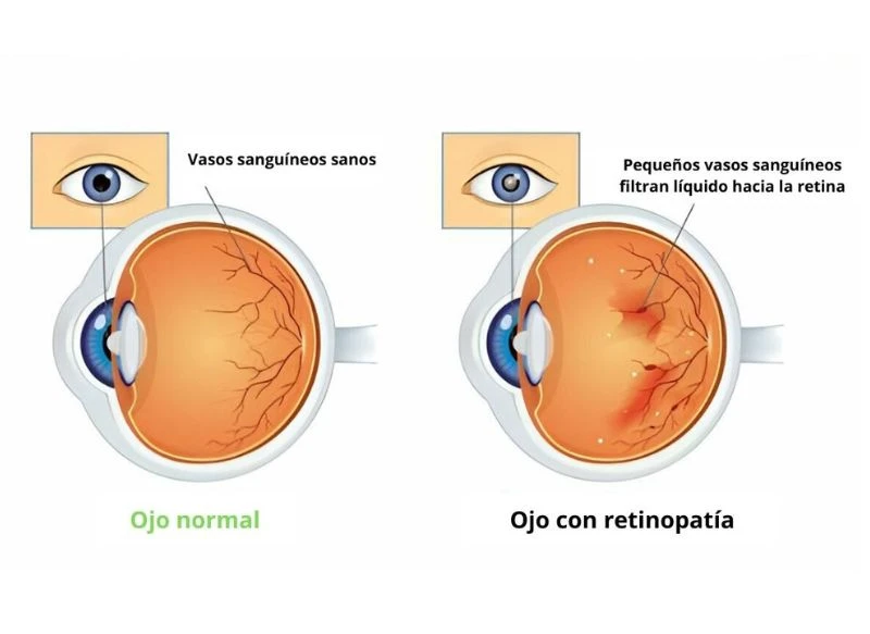 Retinopatía diabética