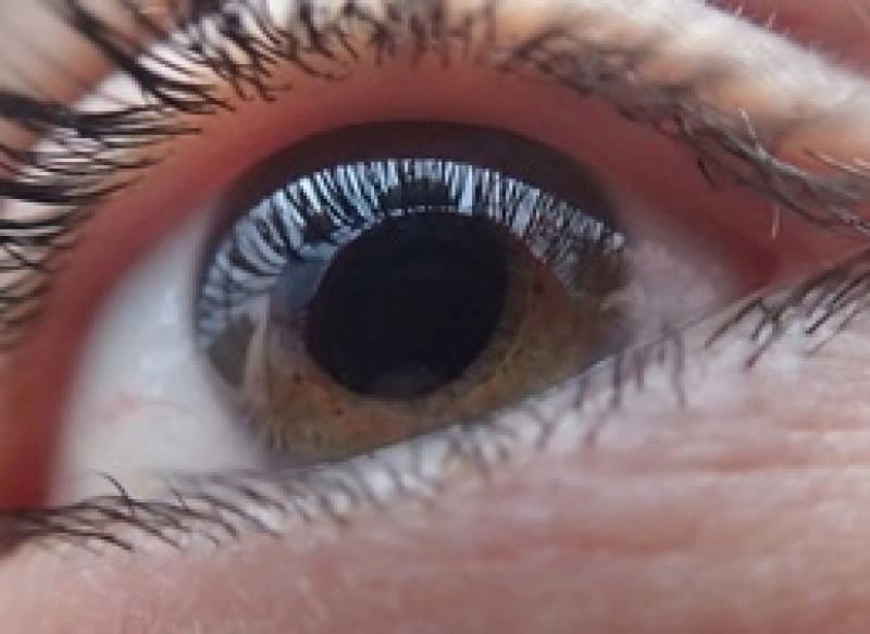 Lentes intraoculares para remediar las cataratas