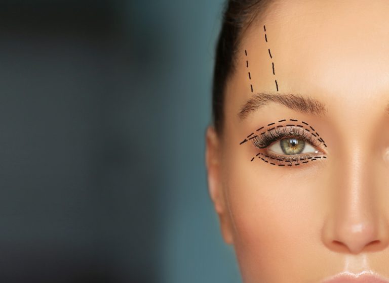mitos y verdades de la blefaroplastia