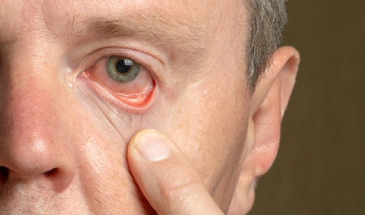 Alergias en los ojos: Qué es, síntomas y tratamientos