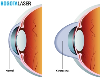 ¿Cuáles son las consecuencias del queratocono?