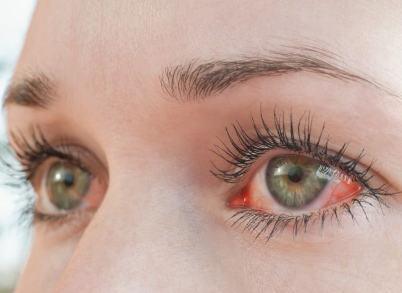 ¿Qué significan las venas rojas en los ojos?