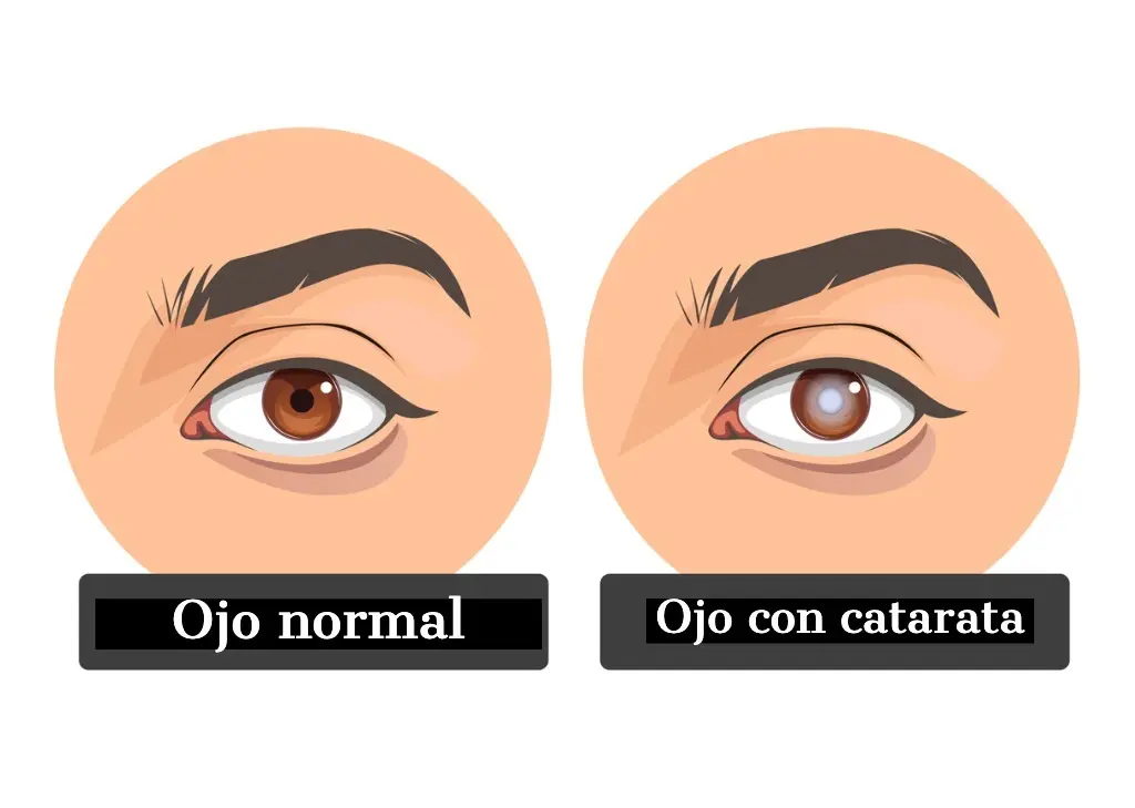 ¿Qué son las cataratas y por qué aparecen?