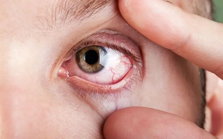 enfermedades comunes en los ojos