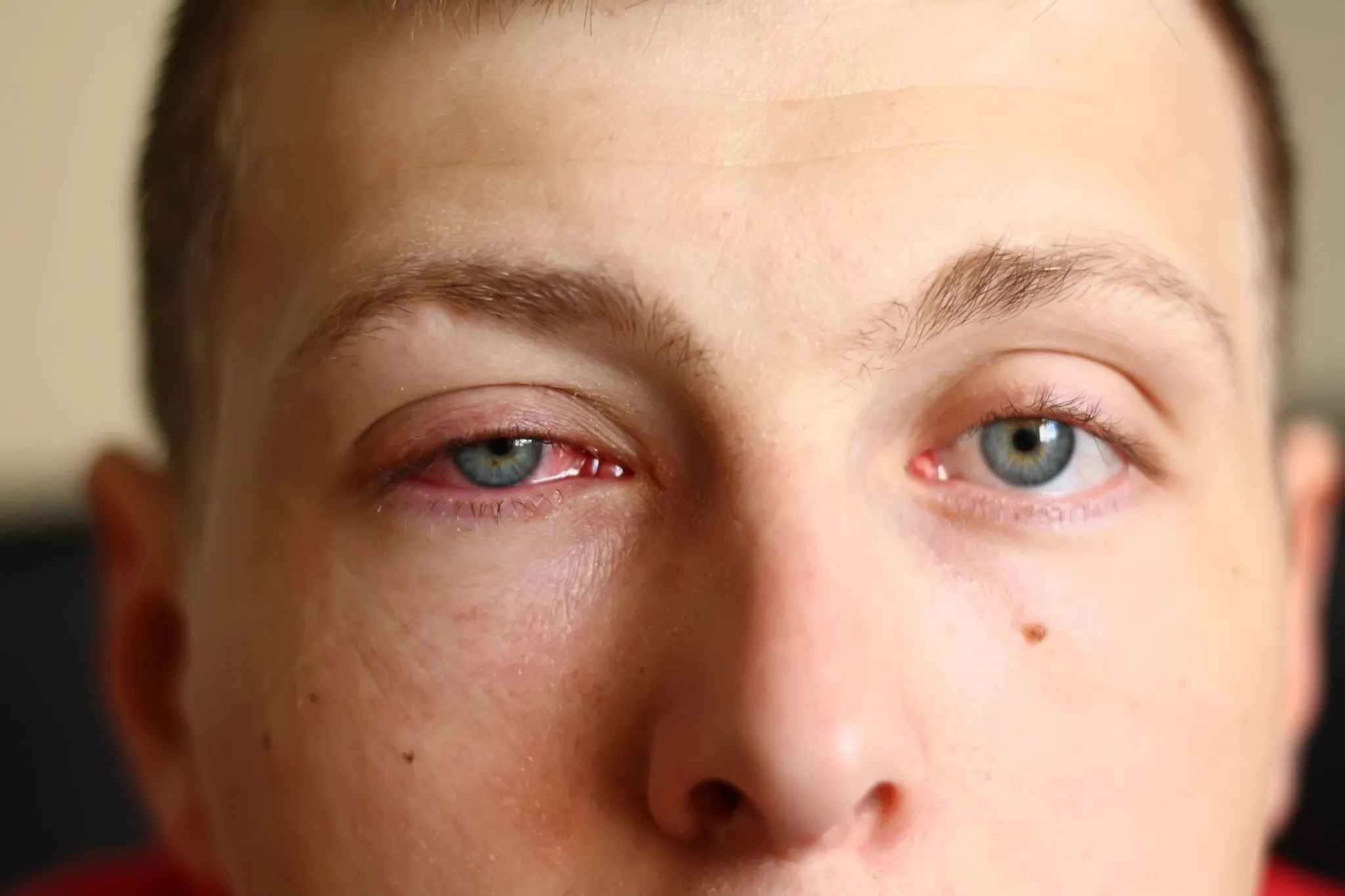Conjuntivitis