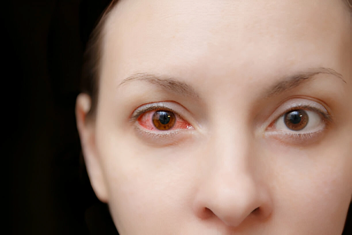 Conjuntivitis